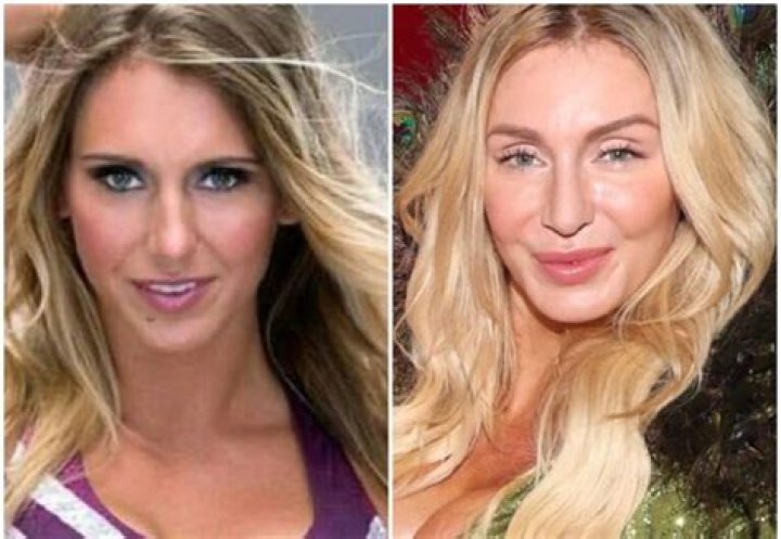 Charlotte Flair Before And After Surgery Pics, Age Wiki And Family |