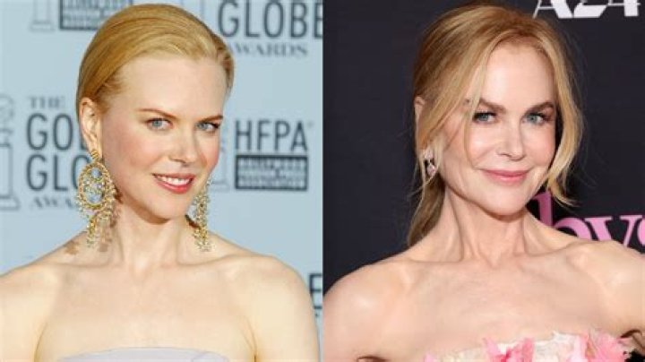 Nicole Kidman Facelift Plastic Surgery Before And After