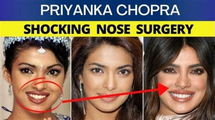Unveiling Priyanka Chopra's Transformation: Discoveries Before Nose Surgery